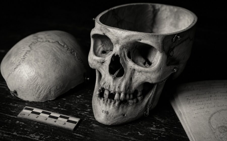 Hand-sawn 19th century anatomical preparation skull with unscrewed calotte, brass temporal screws, iron mandibular spring, forensic ruler, archival notes — black and white documentary photograph