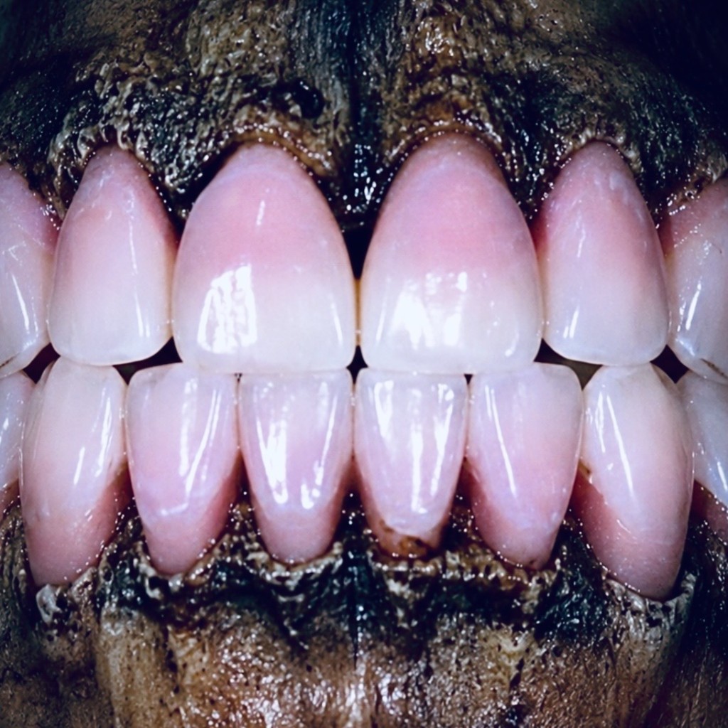 Postmortem pink discoloration of human teeth, classic pink teeth phenomenon in forensic odontology