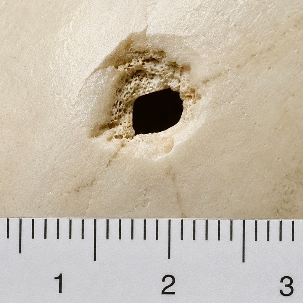 Exit wound close-up: raised outer table margin and tensile fractures indicate exit direction. Scale bar 3 cm.