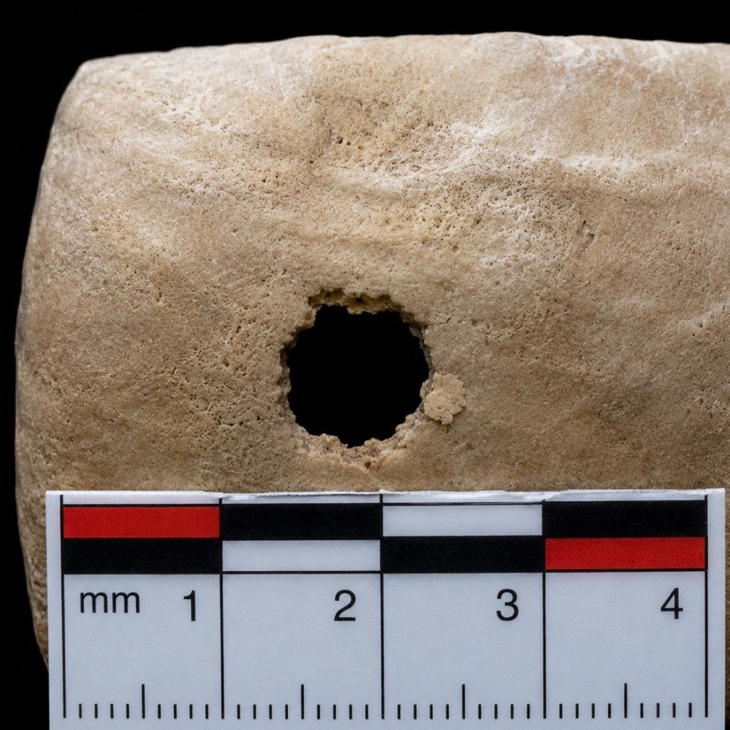 Entry wound in the parietal bone with internal beveling on the endocranial surface. ABFO forensic scale, 4 cm.