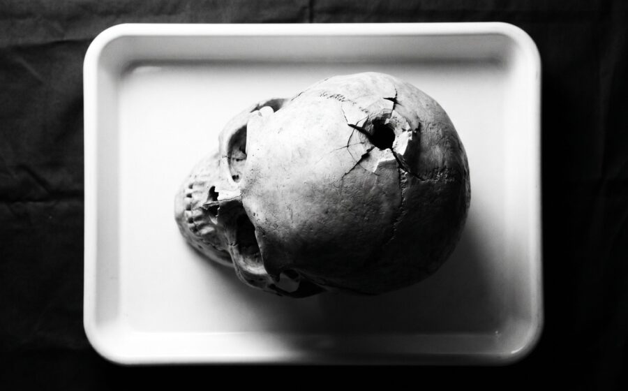 Menschlicher Schädel mit Schussdefekt und äußerer Auskerbung am Os parietale, forensische Dokumentarfotografie