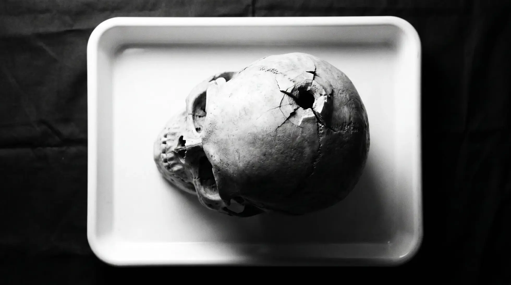 A human skull with a gunshot defect and radiating fractures lying in a white tray, on what the beveled rim reveals