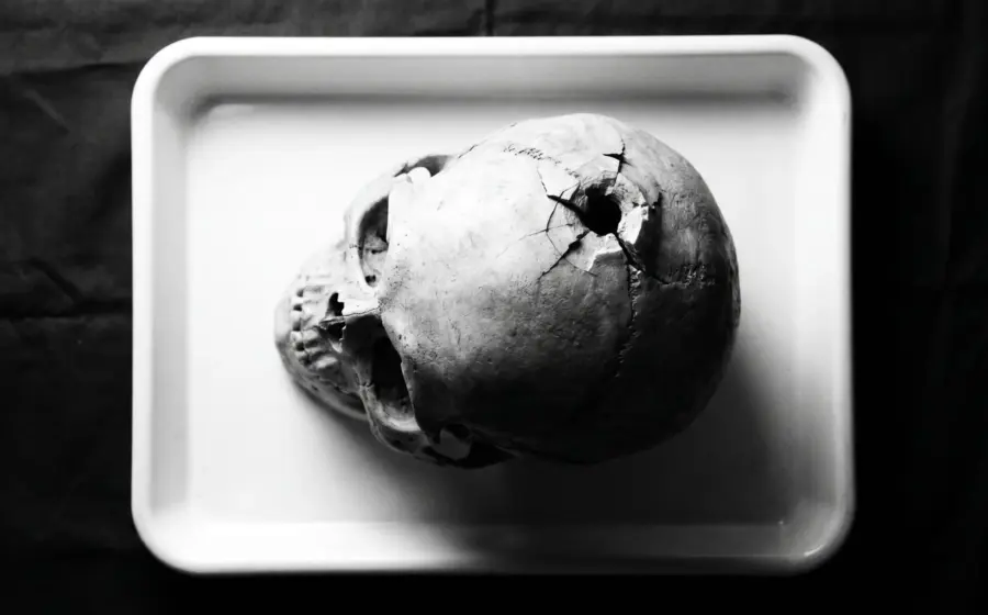 A human skull with a gunshot defect and radiating fractures lying in a white tray, on what the beveled rim reveals