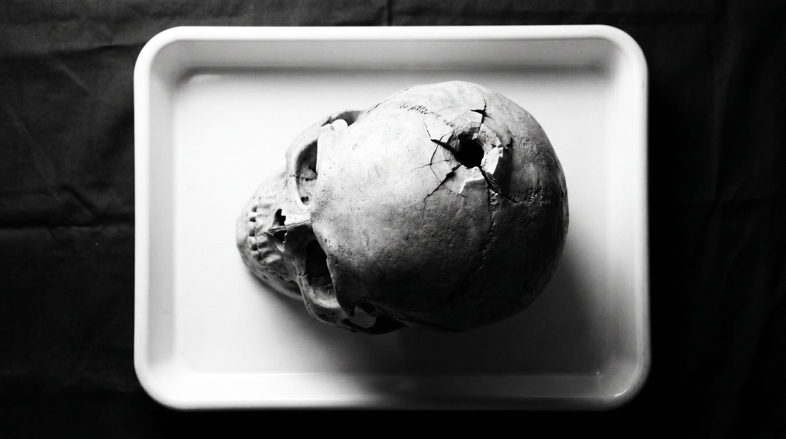 Menschlicher Schädel mit Schussdefekt und äußerer Auskerbung am Os parietale, forensische Dokumentarfotografie